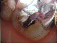 銀歯の下１.jpg